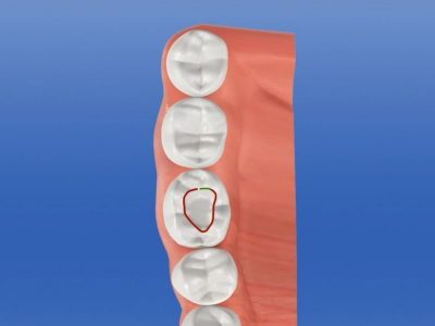 CAD-CAM Reconstrucción de diente con restauración onlay-inlay