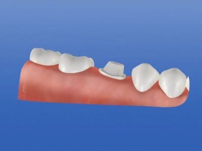 CAD-CAM Reposición protésica de diente con corona