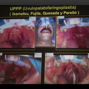 Curso apnea obstructiva del sueño Dr. Emilio Macias Escalada